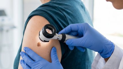 Muertes por cáncer a la piel aumentaron 60% en la última década en Chile