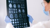¿Cómo saber si me está dando un accidente cerebrovascular (ACV)?